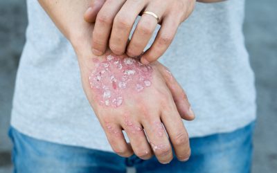 Tuesday 29 October: World Psoriasis Day